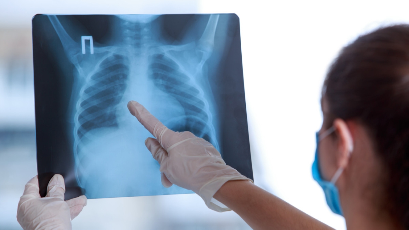 Bahaya Penyakit Pneumonia: 1.3 Juta Korban dan Ancaman Kesehatan Masyarakat