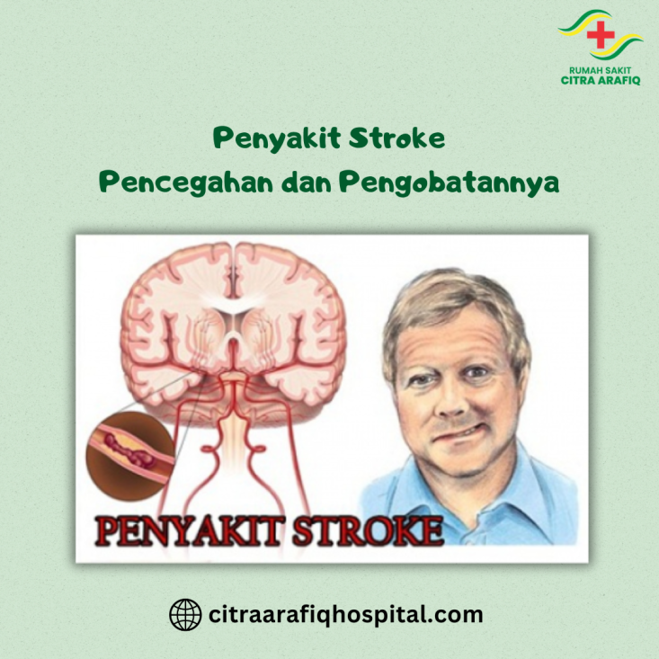 Penyakit Stroke: Pencegahan dan Pengobatannya