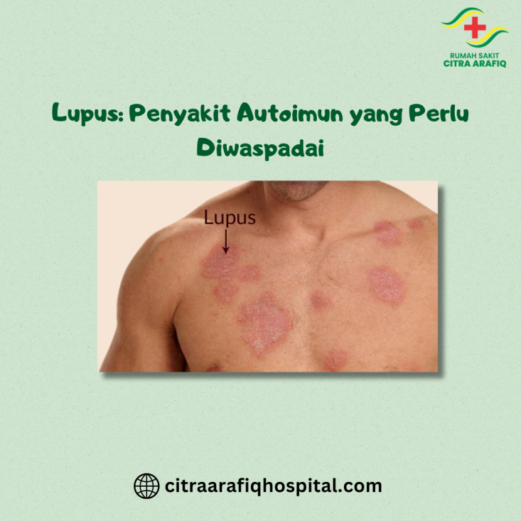 Lupus: Penyakit Autoimun yang Perlu Diwaspadai